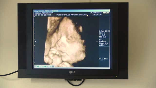 3D, 4D Ultrasound
