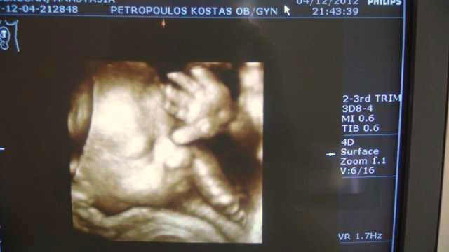 3D, 4D Ultrasound