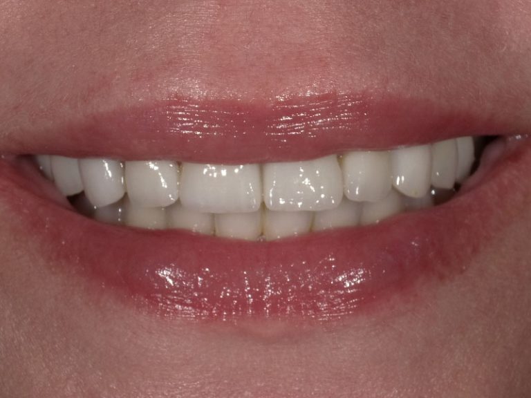 All-ceramic veneers