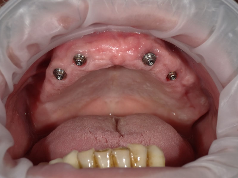 Implants