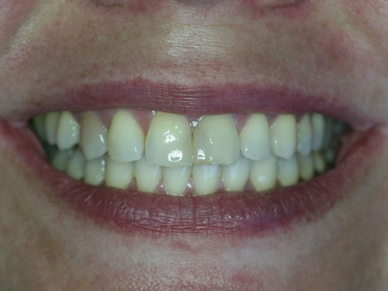 All-ceramic veneers