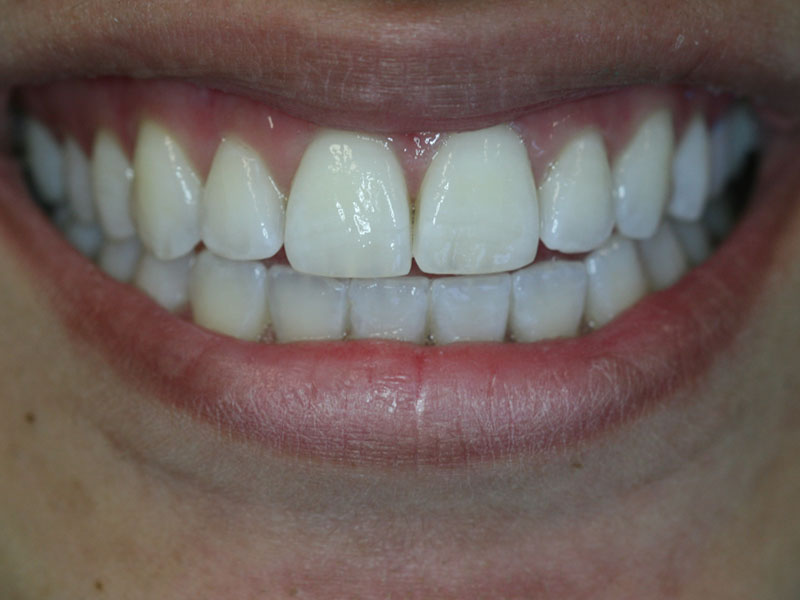 Teeth whitening