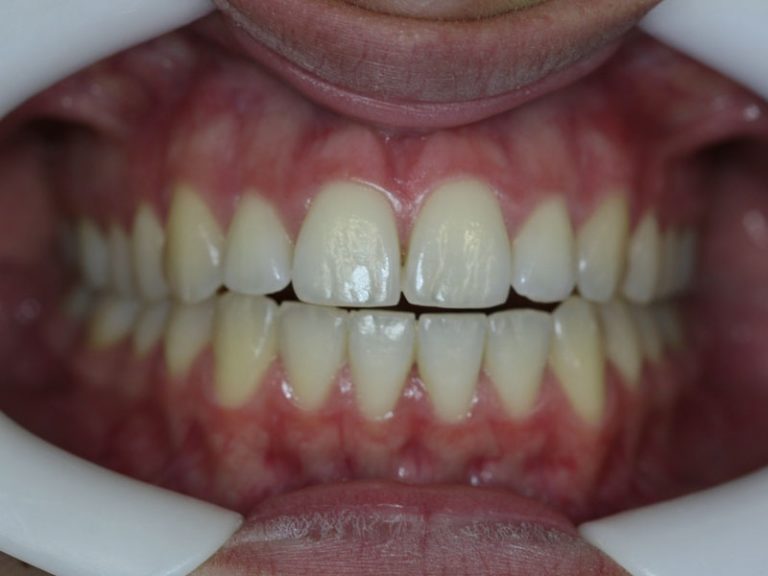 Teeth whitening