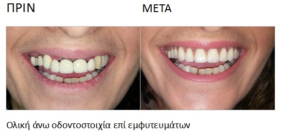 Ολική άνω οδοντοστοιχία επί εμφυτευμάτων