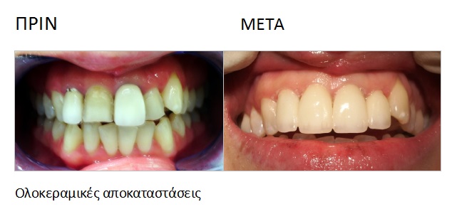 Ολοκεραμική αποκατάσταση