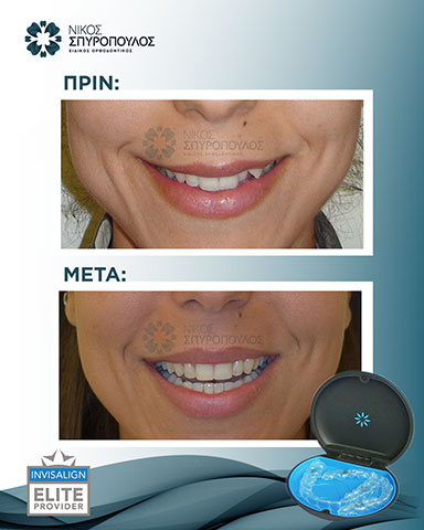Αποτέλεσμα με Ορθοδοντική μέθοδο Invisalign