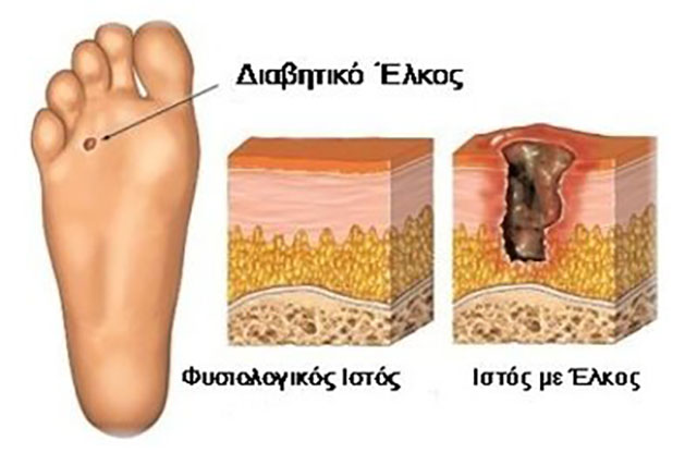 Διαβητικό πόδι
