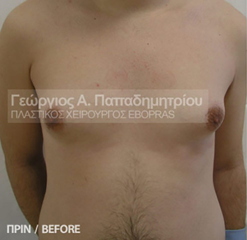 Γυναικομαστία στον άνδρα πριν