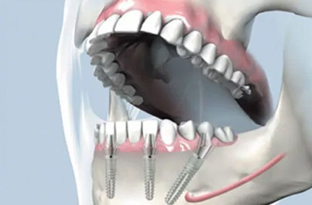 TOOTHCARE - ΣΠΙΝΟΣ ΠΕΤΡΟΣ DDS, MSc: Φωτογραφίες & Βίντεο