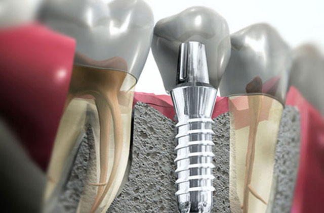 TOOTHCARE - ΣΠΙΝΟΣ ΠΕΤΡΟΣ DDS, MSc: Φωτογραφίες & Βίντεο