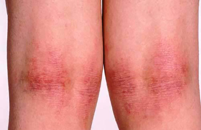Atopic Dermatitis