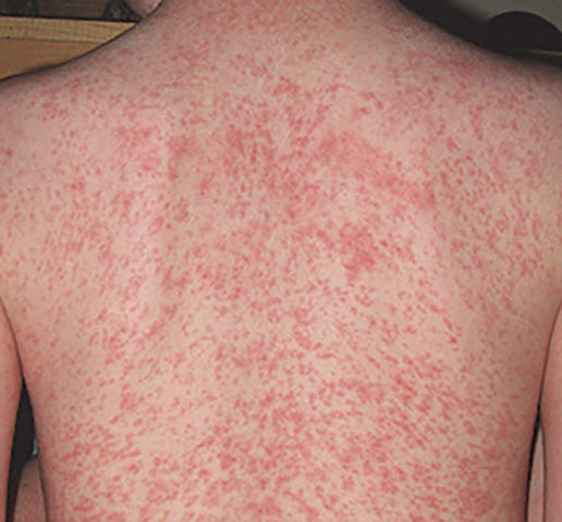 Drug Allergy