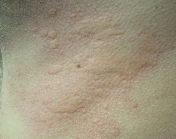 Urticaria