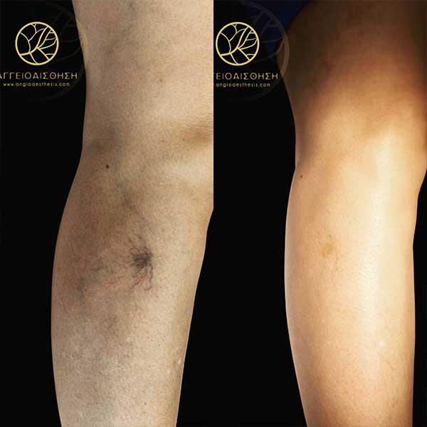 Foam Sclerotherapy