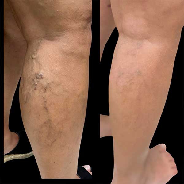 Ultrasound guided foam sclerotherapy