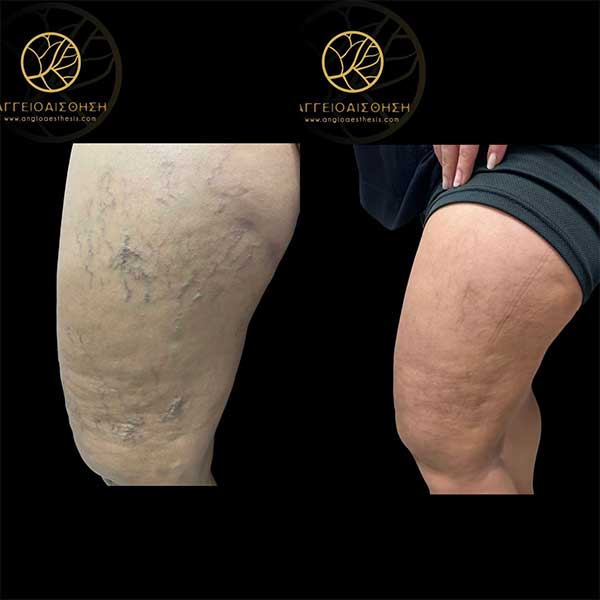Thigh vein treatment