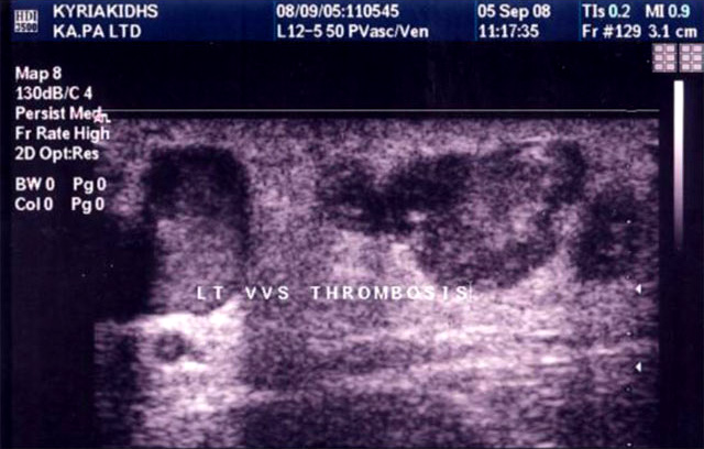 Thrombosis of the Venous Nodes of the Great Saphenous Vein