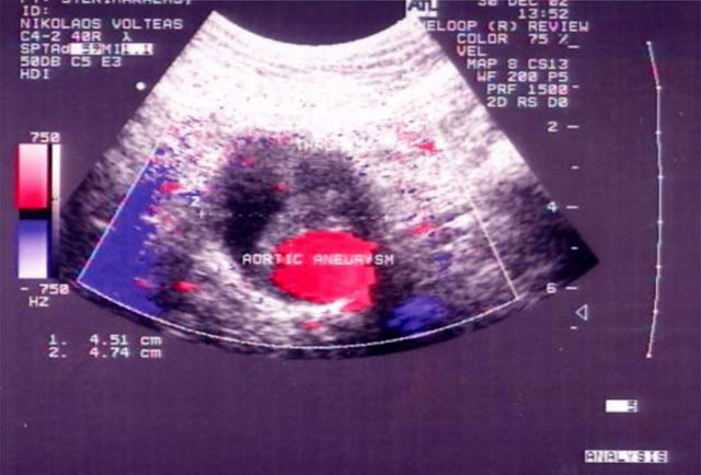 Thrombosis of the Great Saphenous Vein