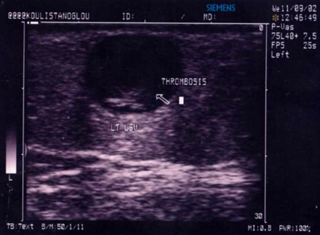 Abdominal Aortic Aneurysm
