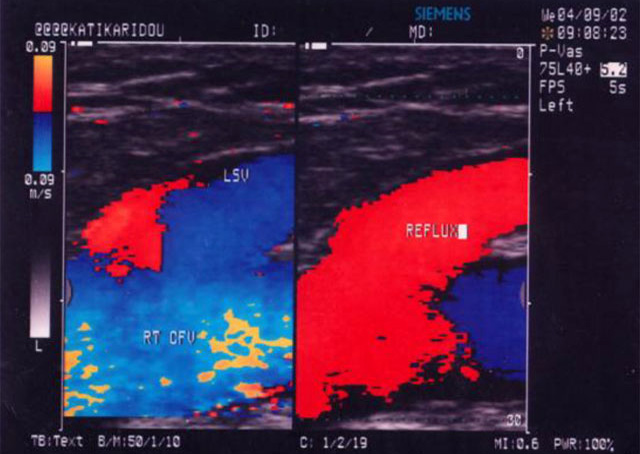 Insufficiency of the Great Saphenous Vein