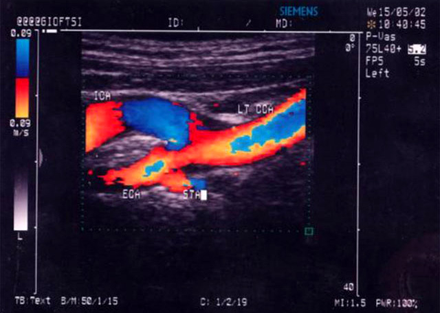 Carotid Artery Dissection