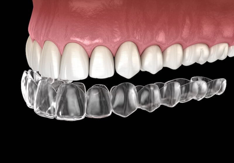 Διαφανείς νάρθηκες - Invisalign