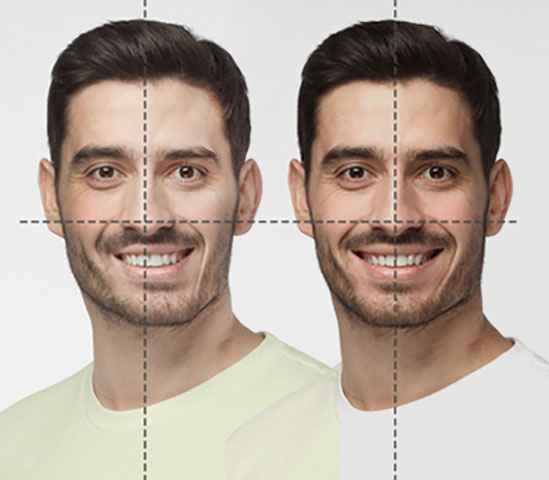 Facial asymmetry